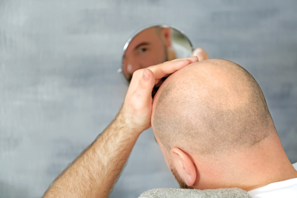 Hair Transplants: What You Need to Know