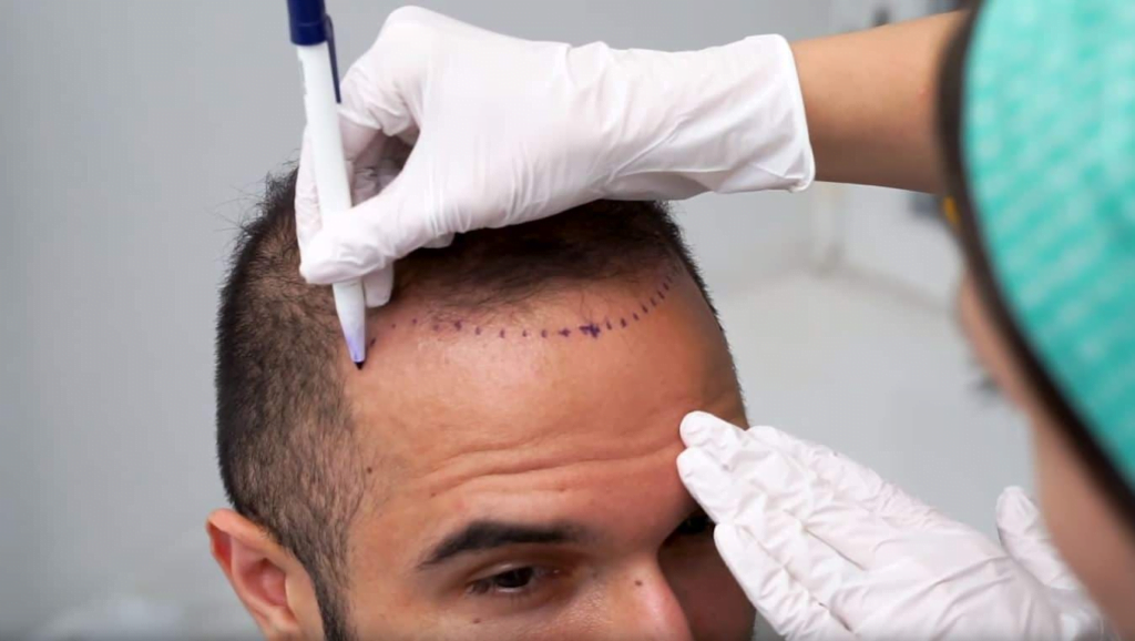 Hair Transplant Cost in Turkey: A Complete Guide