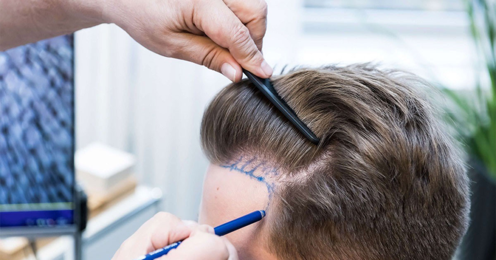 What is the success rate of hair transplant?