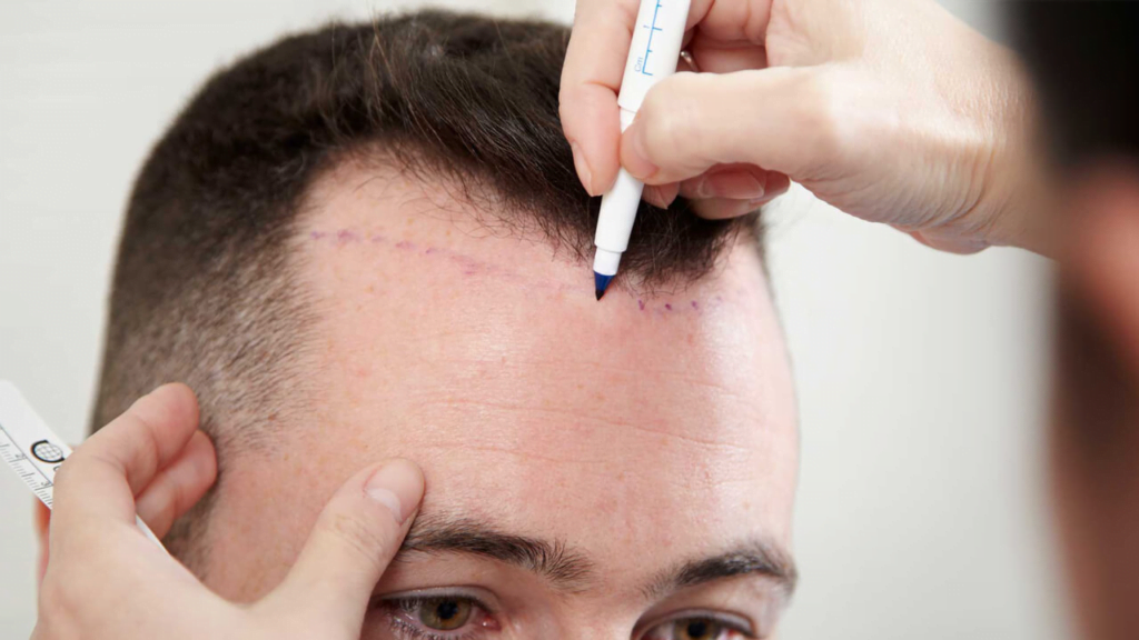 Where is the best place in the world to get a hair transplant?