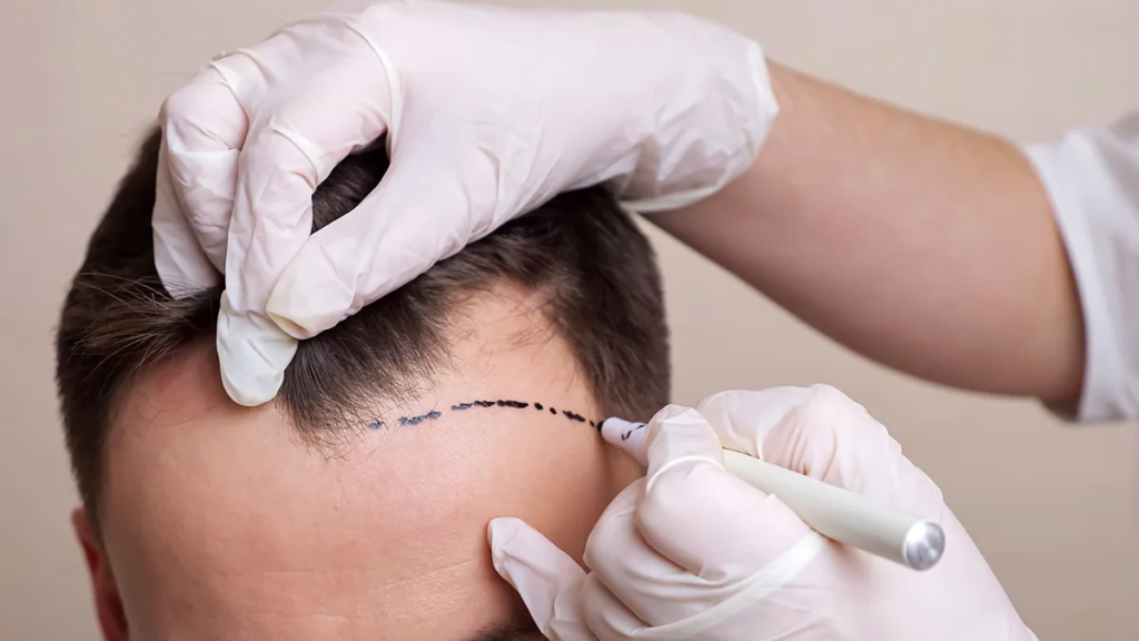 Can you fix your hairline with a hair transplant?