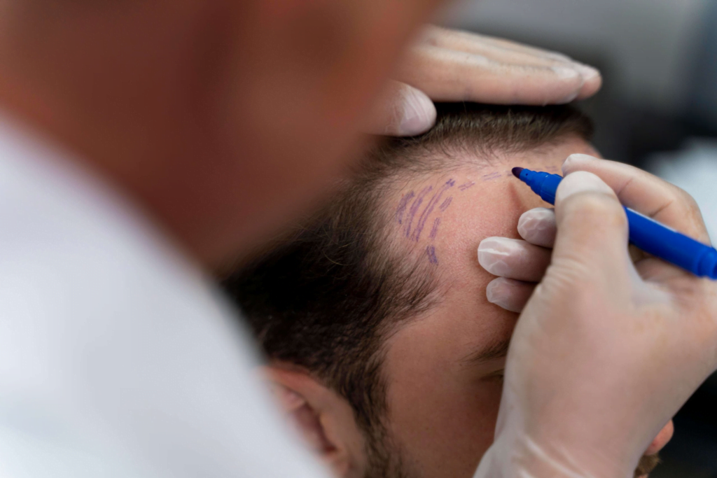 Can you fix your hairline with a hair transplant?