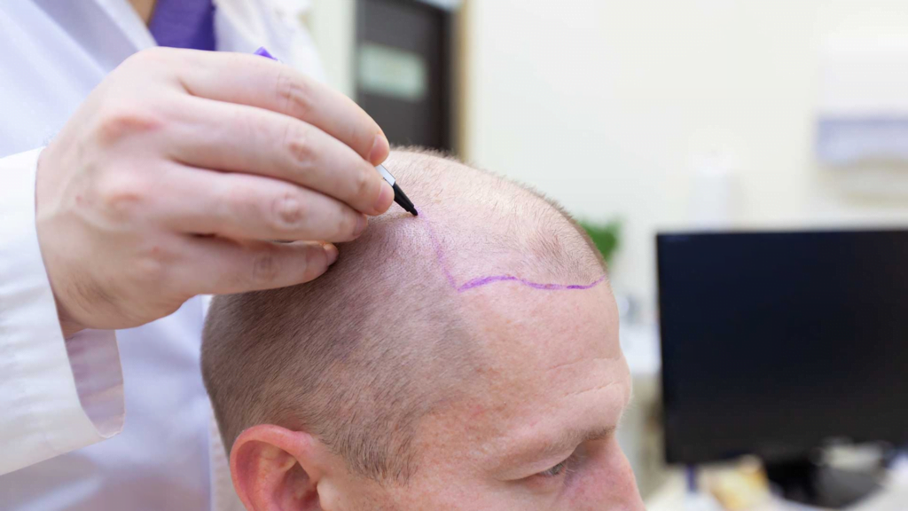 Unpacking Hair Replacement Surgery Costs in the U.S.: City-by-City Comparison