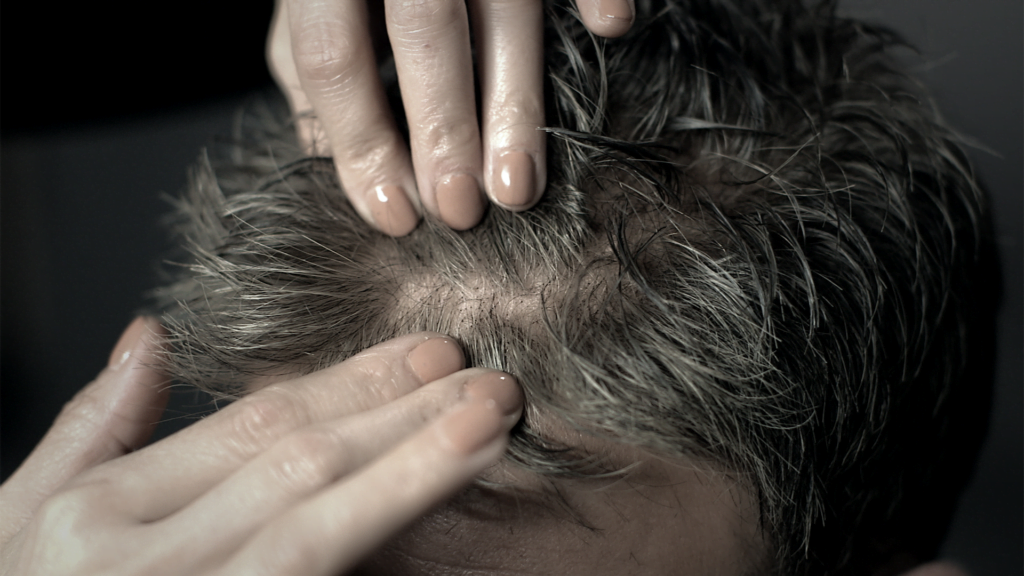 Is Turkey or South Korea Better for Hair Transplant?