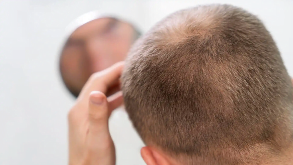 What happens 10 years after a hair transplant?