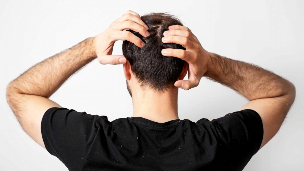 What happens 10 years after a hair transplant?