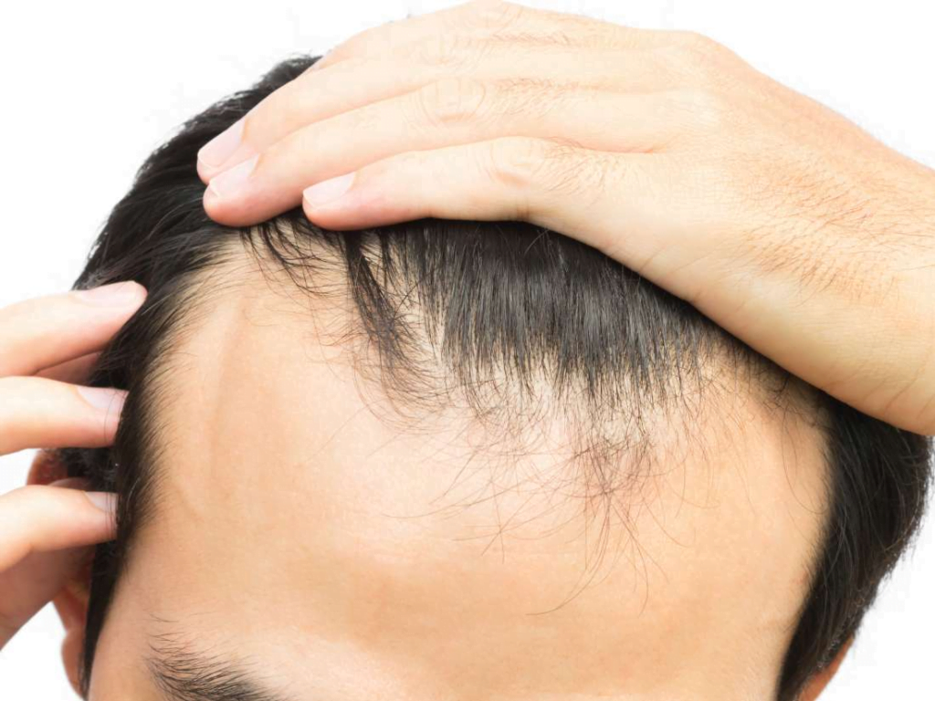 5 Things You Need to Know About M-Shaped Hairlines