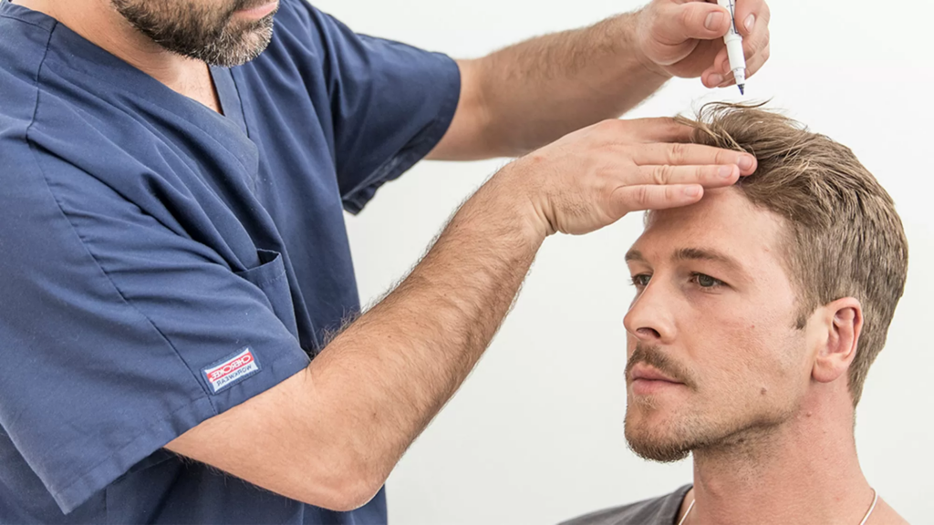 ¿Qué es la cirugía de reducción del cuero cabelludo?