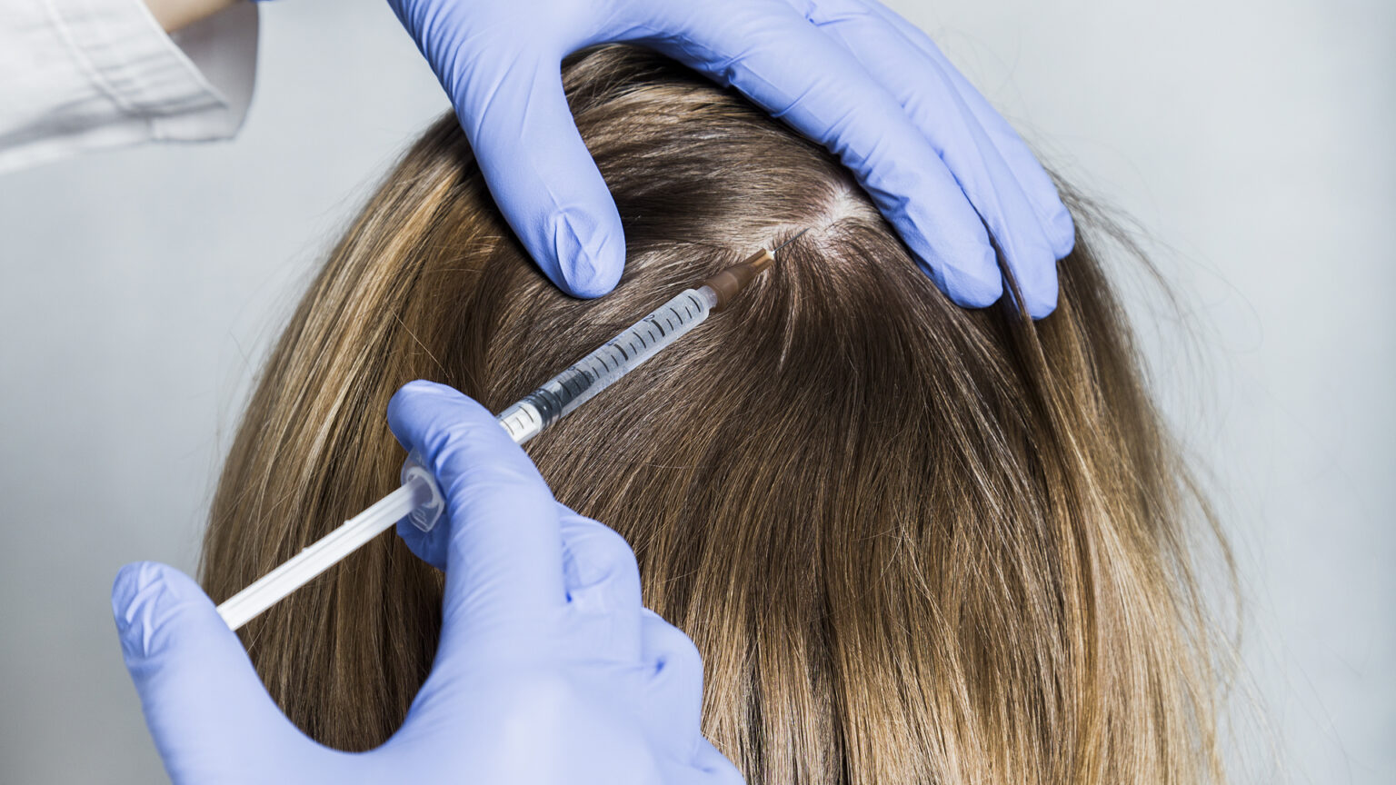 Wie wirkt sich eine Hormonersatztherapie auf eine Haartransplantation